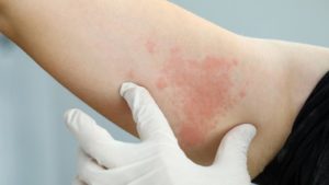 Alergia ao suor