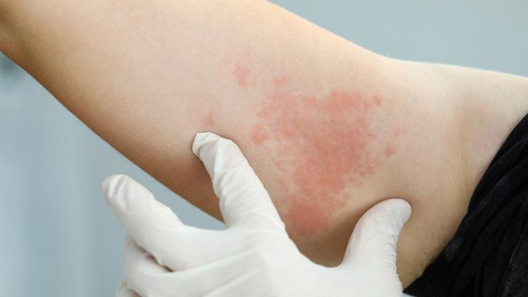 Alergia ao suor