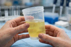Exame de urina com amostra turva amarelada sintoma de infecção urinária bacteriana